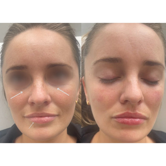 Dermal Fillers in Norwich