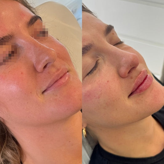 Lip Fillers Treatment