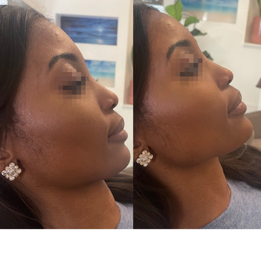 Chin Filler Treatment