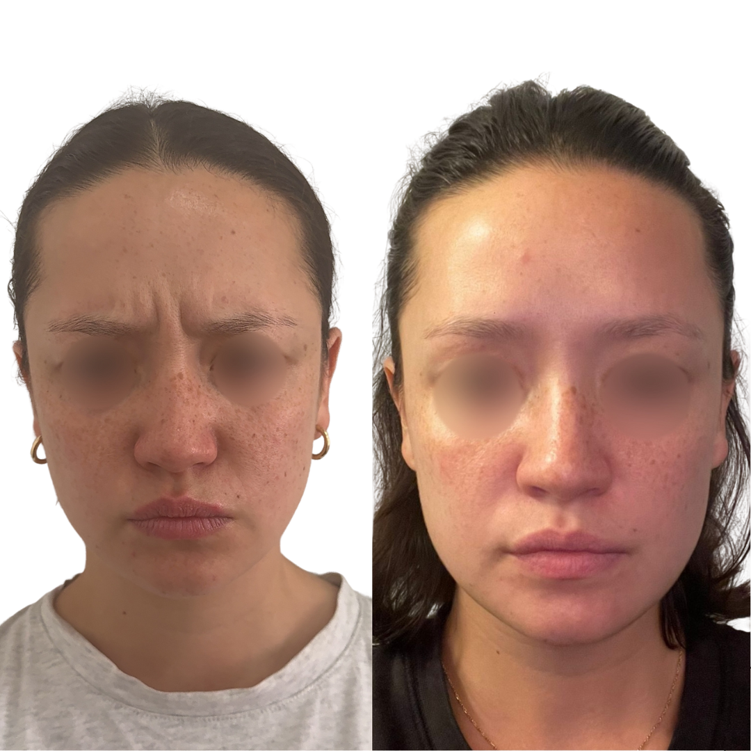 Anti-Wrinkle Injections