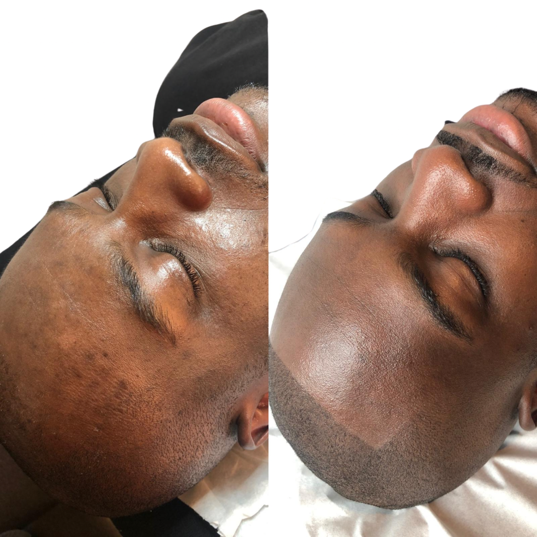 Advanced Microneedling