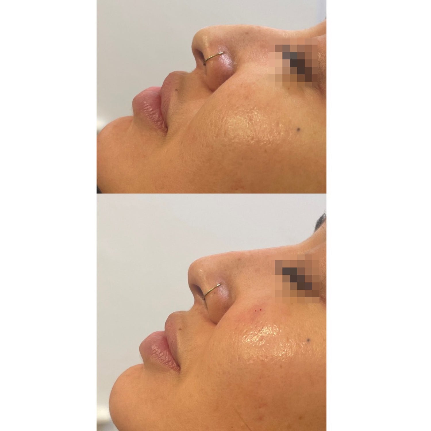 Non-Surgical Rhinoplasty