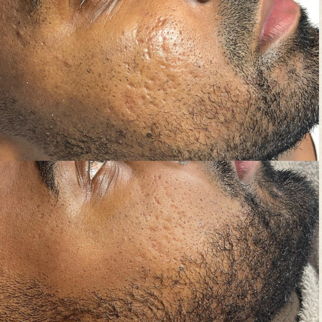 Advanced Microneedling 
