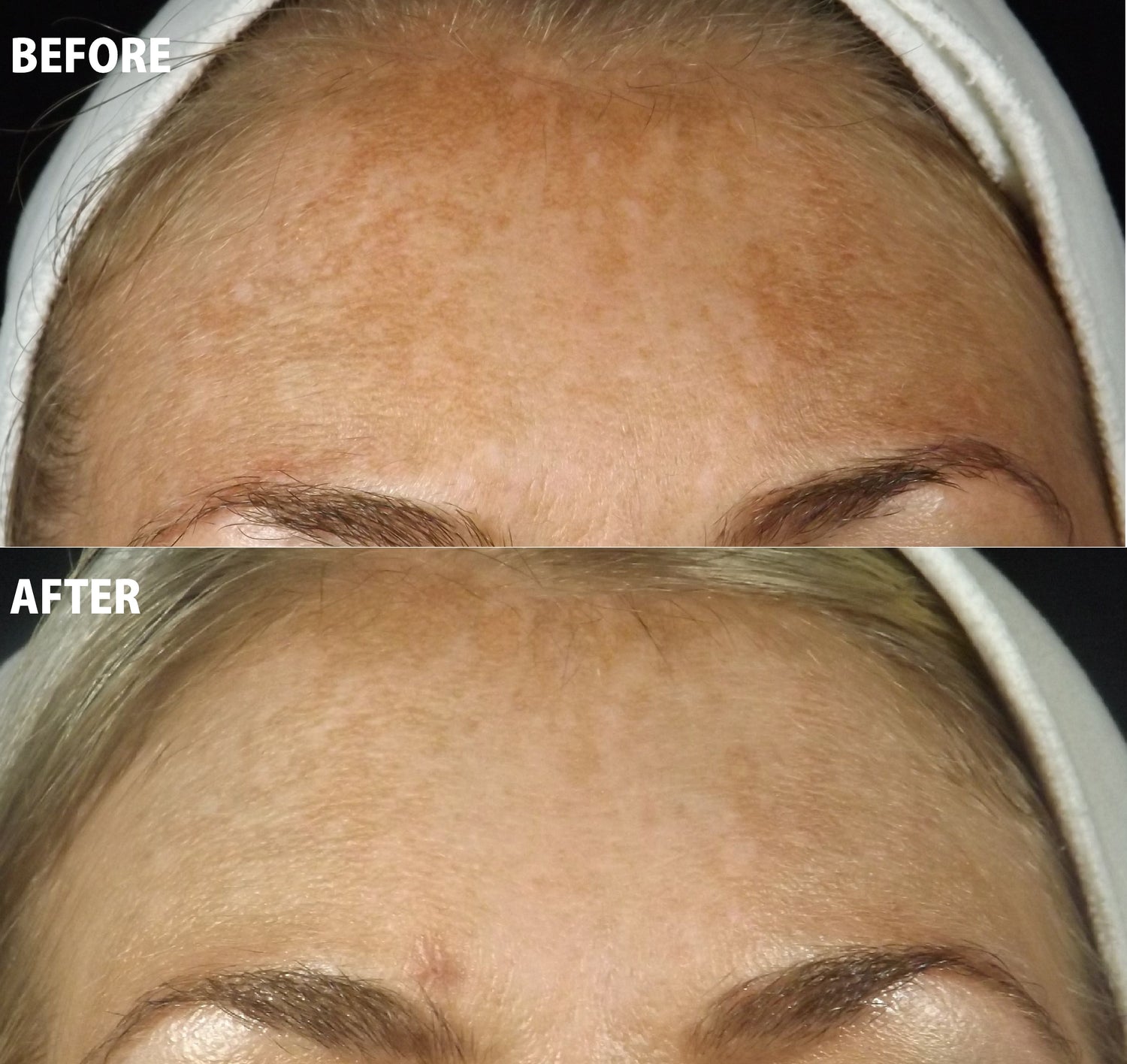 Chemical Peel Treatment